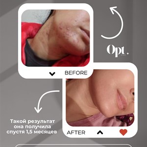 Акне проблема требующая комплексного подхода и грамотного